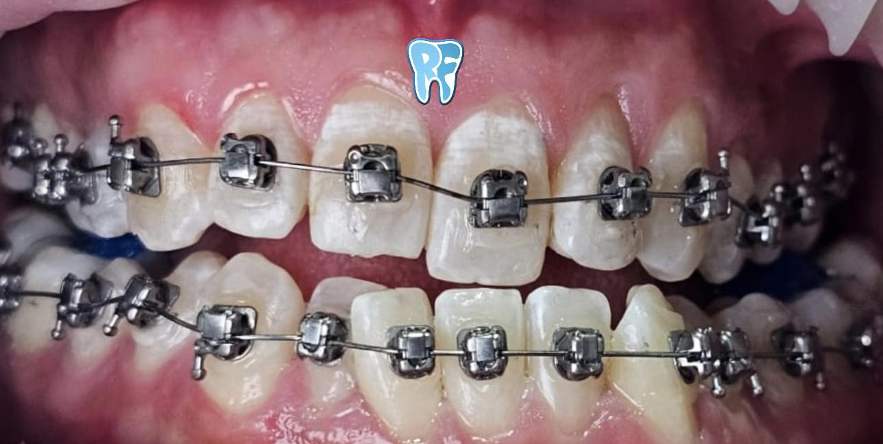 Orthodontic Appliance